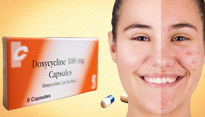 Doxycycline 100mg used for acne treatment showing before and after skin improvement results.