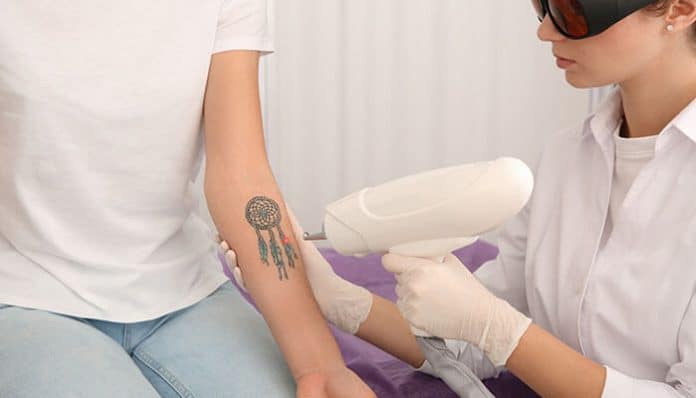Professional using laser treatment to minimize pain during tattoo removal on a patient’s arm